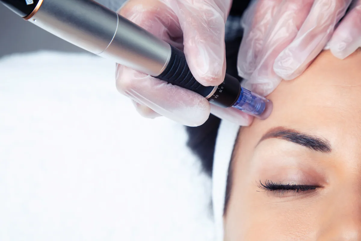 Microneedling