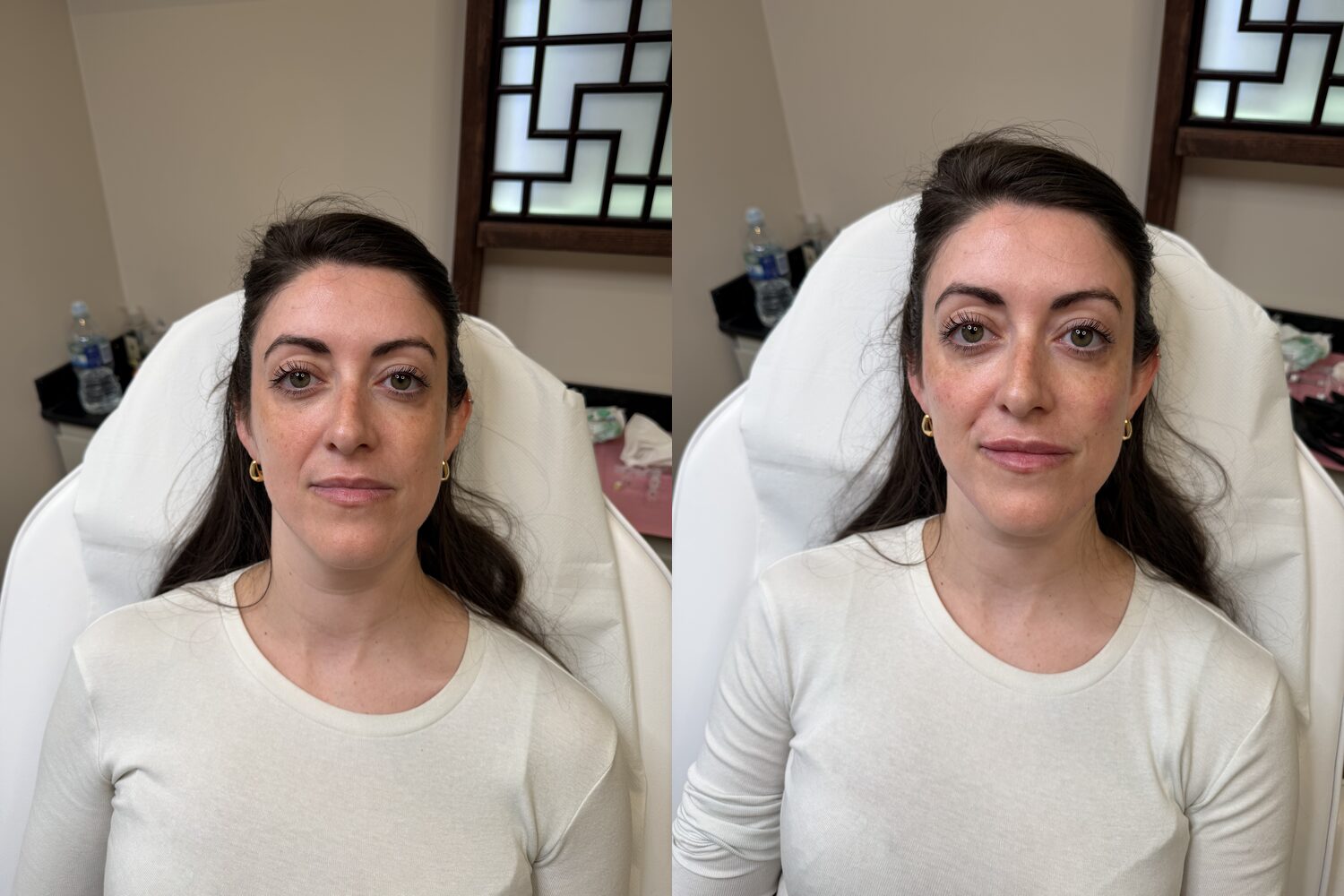 Before and after facial balancing with dermal filler at Visage Medispa, Weybridge, refreshed, harmonised features.