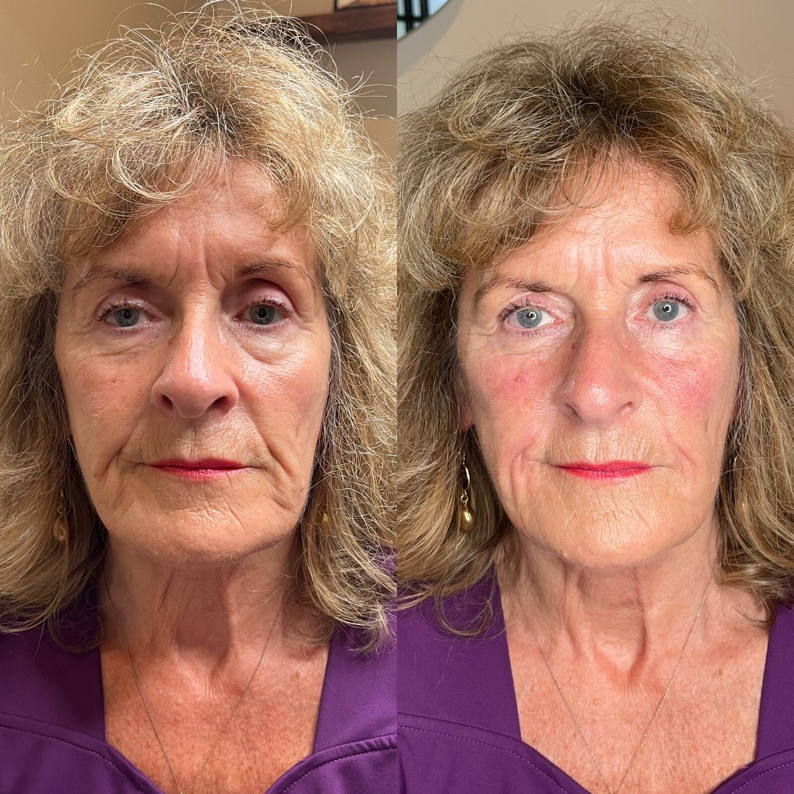 Before and after facial rejuvenation with dermal filler in Surrey, a softer, more rested appearance.