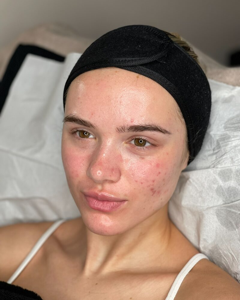 After — Before and after Hydrafacial in Surrey, calmer, clearer skin with reduced breakouts and redness.