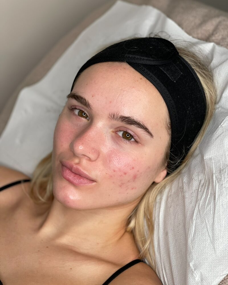 Before — Before and after Hydrafacial in Surrey, calmer, clearer skin with reduced breakouts and redness.