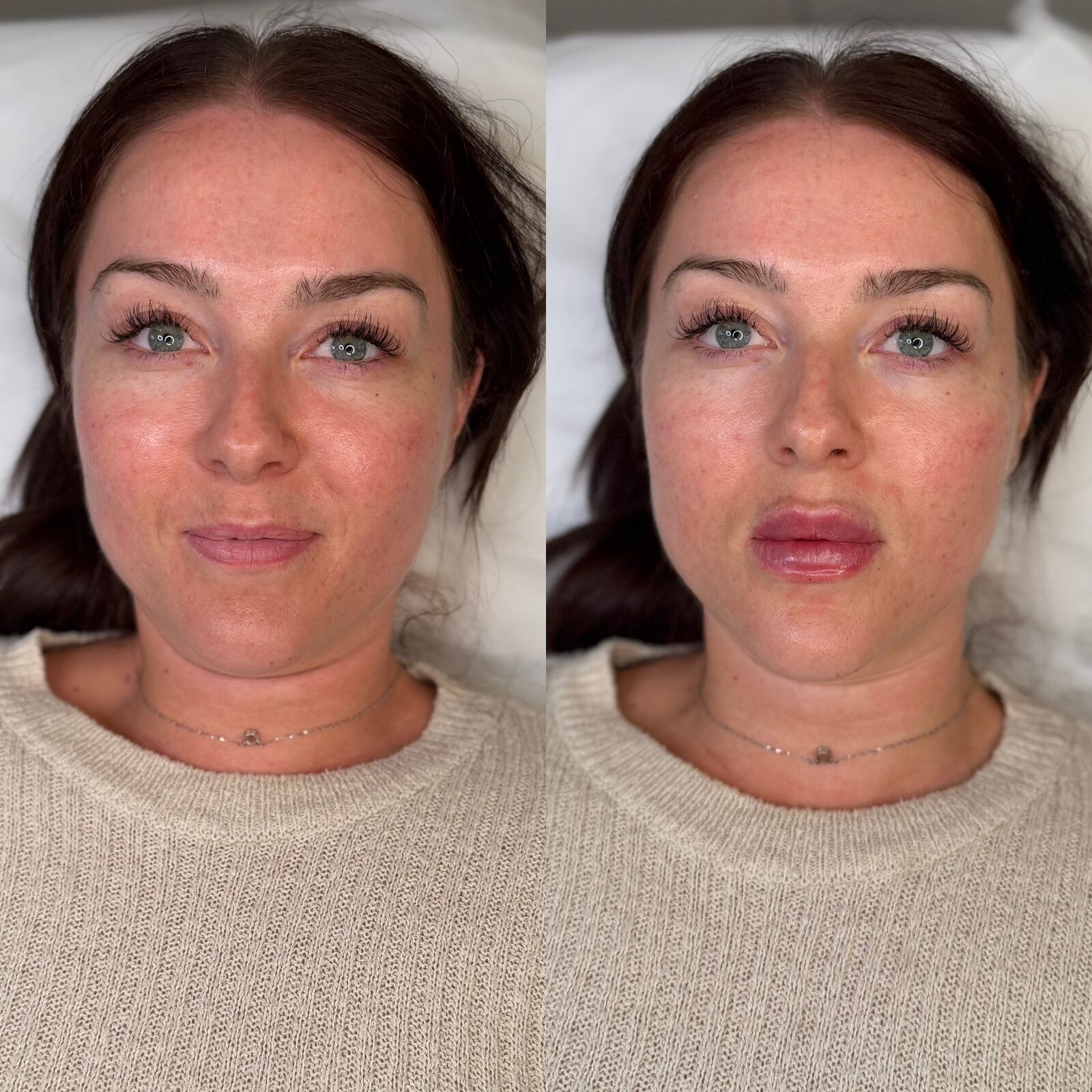 Before and after natural lip filler results at Visage Medispa, Weybridge, softly enhanced, balanced lips.