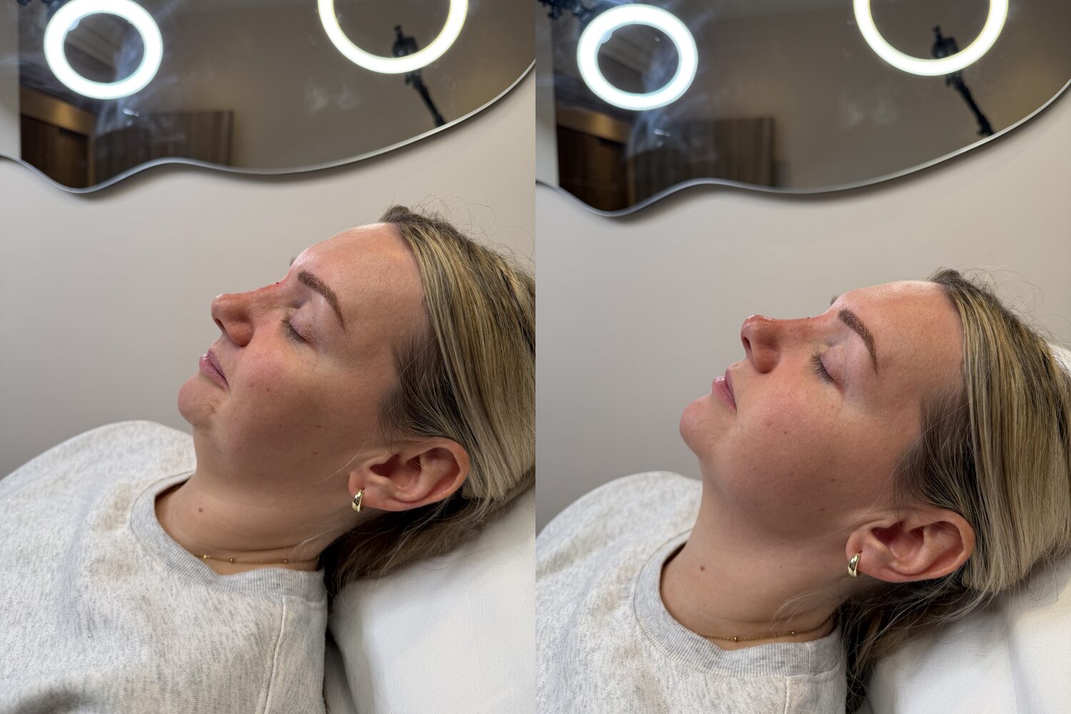 Before and after non-surgical rhinoplasty with dermal filler at Visage Medispa, Weybridge, a smoother nasal profile.