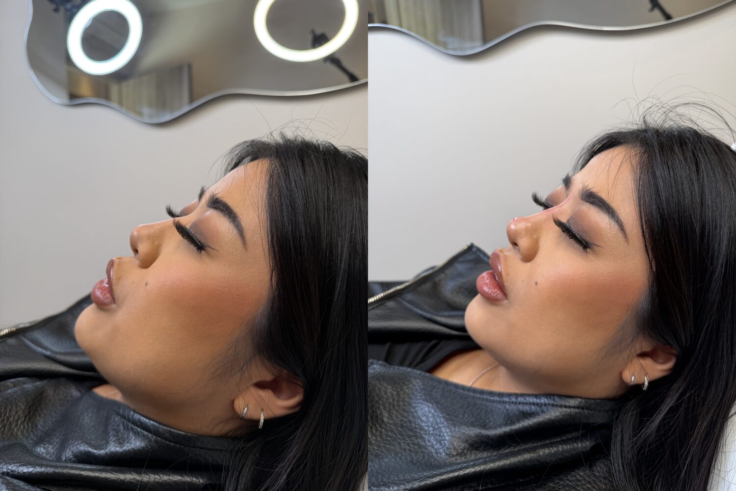 Before and after non-surgical rhinoplasty results in Surrey, refined nasal bridge and tip with dermal filler.