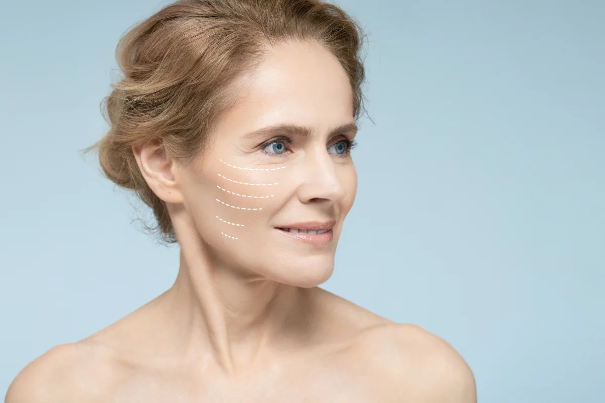 Sculptra PLLA
