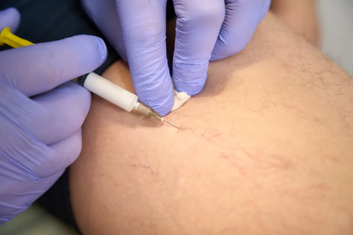 Thread Vein Removal